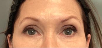 After Results for Voluma