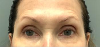 Before Results for Voluma