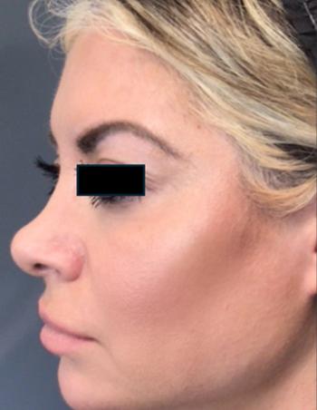 After Results for Voluma