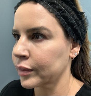 Before Results for Volux