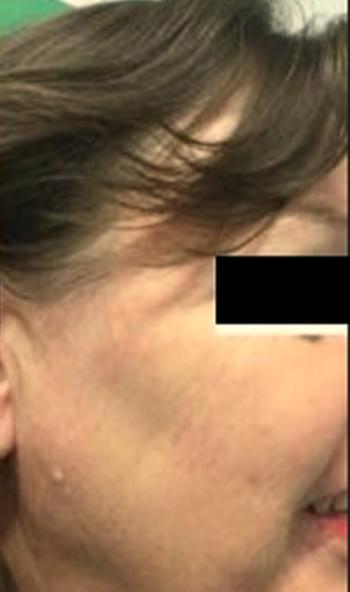 After Results for Yag Laser
