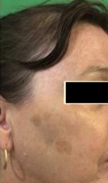 Before Results for Yag Laser