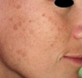 Before Results for Yag Laser