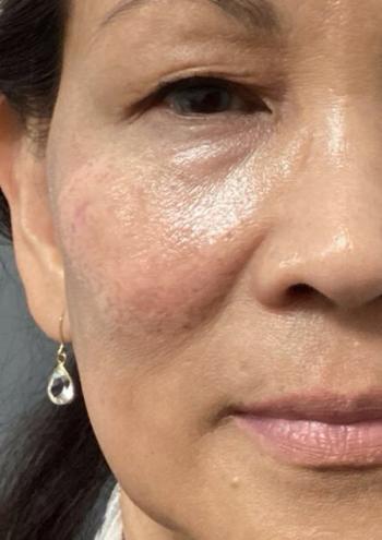 After Results for Yag Laser