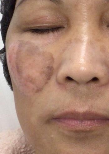 Before Results for Yag Laser