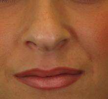 After Results for Juvederm