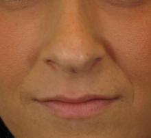 Before Results for Botox