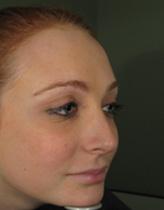 Before Results for Juvederm