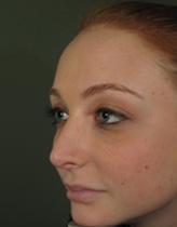 Before Results for Juvederm