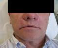 After Results for Botox, Juvederm, Liquid Facelift, Cosmetic