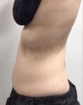 After Results for Coolsculpting
