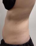 Before Results for Coolsculpting