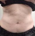 After Results for Coolsculpting