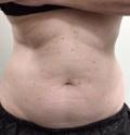 Before Results for Coolsculpting