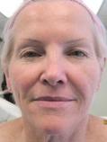 Before Results for Botox, Radiesse, Cosmetic, CO2 Laser Resurfacing
