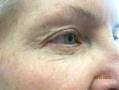 Before Results for Botox, Radiesse, Cosmetic, CO2 Laser Resurfacing