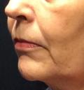 Before Results for Defyne