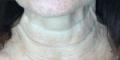 After Results for Botox