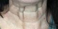 Before Results for Botox