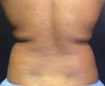 After Results for Cosmetic, Coolsculpting