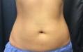 After Results for Cosmetic, Coolsculpting