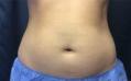 Before Results for Cosmetic, Coolsculpting