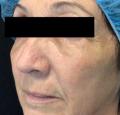 After Results for Erbium Laser
