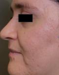 After Results for Erbium Laser