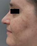 Before Results for Erbium Laser