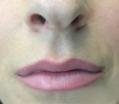 After Results for Juvederm, Cosmetic