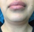 Before Results for Cosmetic, Kybella