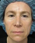 Before Results for Botox, Juvederm, Cosmetic