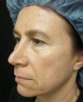 Before Results for Botox, Juvederm, Cosmetic