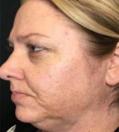 Before Results for Kybella
