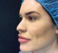 After Results for Voluma, Vitalize Peel