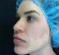 Before Results for Voluma, Vitalize Peel