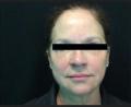 After Results for Liquid Facelift