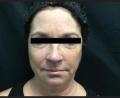 Before Results for Liquid Facelift