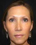 After Results for Juvederm, Radiesse, Dysport, Cosmetic