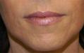 After Results for Juvederm, Radiesse, Dysport, Cosmetic