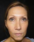 Before Results for Juvederm, Radiesse, Dysport, Cosmetic