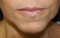 Before Results for Juvederm, Radiesse, Dysport, Cosmetic