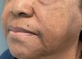 After Results for Morpheus8