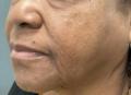 Before Results for Morpheus8