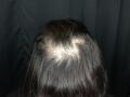 Before Results for PRP