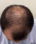 Before Results for PRP