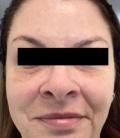 After Results for Restylane