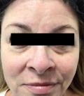 Before Results for Restylane