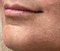 After Results for Restylane