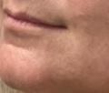 Before Results for Restylane